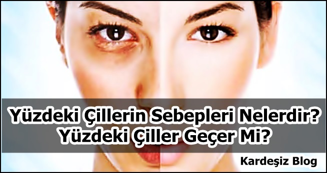 Yüzdeki Çillerin Sebepleri Nelerdir