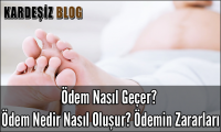 Ödem Nasıl Geçer