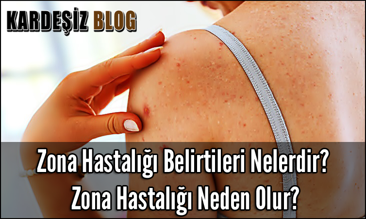 Zona Hastalığı Belirtileri Nelerdir