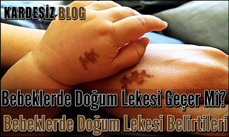 Bebeklerde Doğum Lekesi Geçer Mi