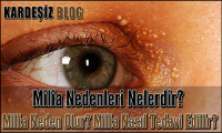 Milia Nedenleri Nelerdir