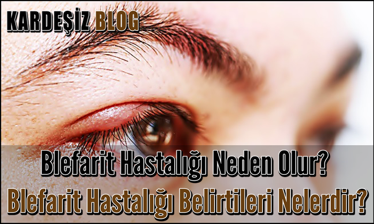 Blefarit Hastalığı Neden Olur