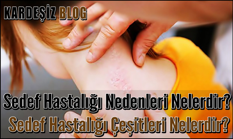 Sedef Hastalığı Nedenleri Nelerdir