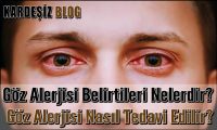 Göz Alerjisi Belirtileri Nelerdir