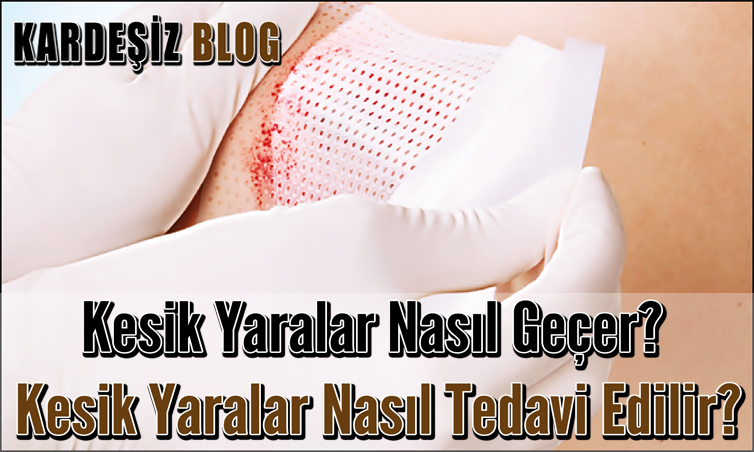 Kesik Yaralar Nasıl Geçer