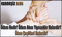 Ödem Nedir