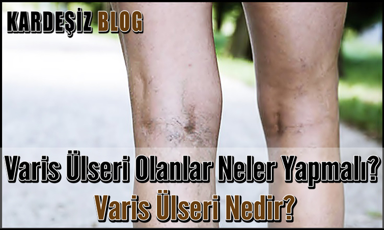 Varis Ülseri Olanlar Neler Yapmalı