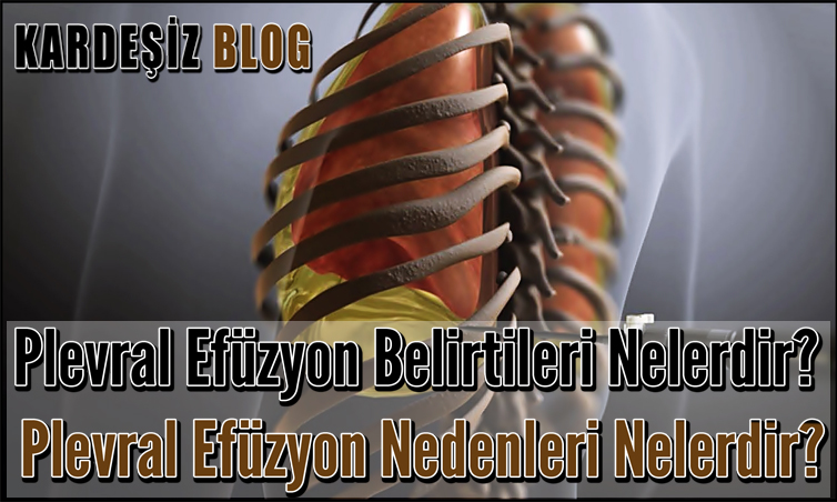 Plevral Efüzyon Belirtileri Nelerdir