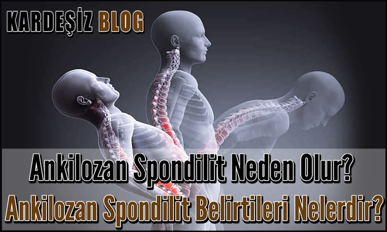 Ankilozan Spondilit Neden Olur