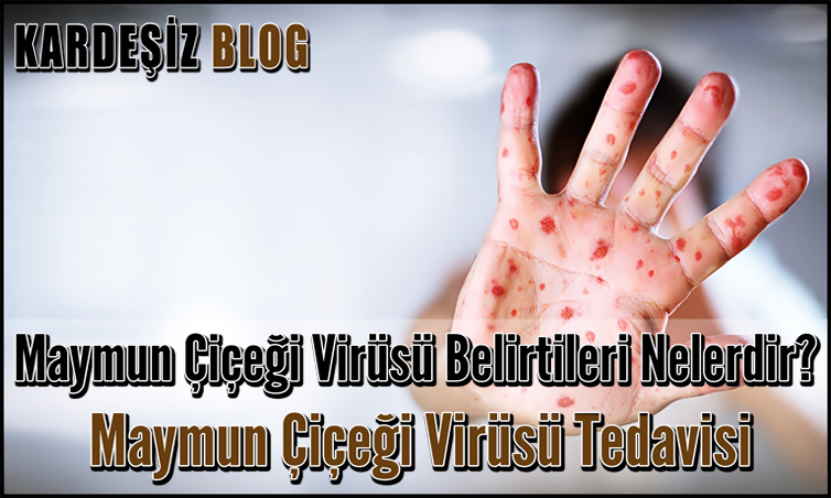 Maymun Çiçeği Virüsü Belirtileri Nelerdir