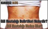 Gül Hastalığı Belirtileri Nelerdir