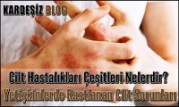 Cilt Hastalıkları Çeşitleri Nelerdir