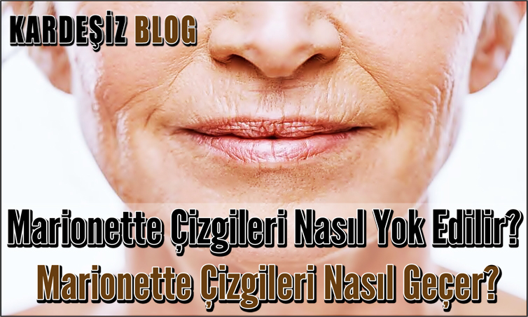 Marionette Çizgileri Nasıl Yok Edilir