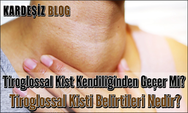 Tiroglossal Kist Kendiliğinden Geçer Mi