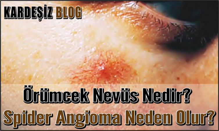 Örümcek Nevüs Nedir