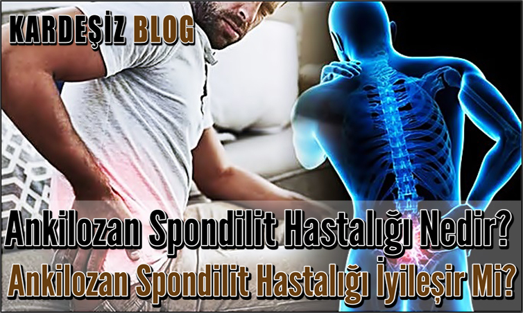 Ankilozan Spondilit Hastalığı Nedir? Ankilozan Spondilit Hastalığı ...