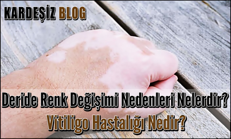 Deride Renk Değişimi Nedenleri Nelerdir