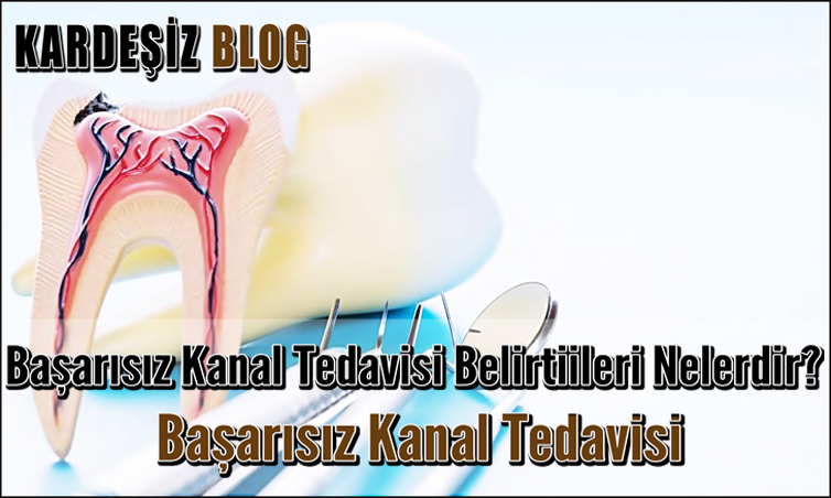 Başarısız Kanal Tedavisi Belirtiileri Nelerdir