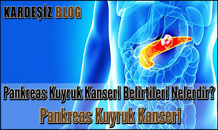 Pankreas Kuyruk Kanseri Belirtileri Nelerdir