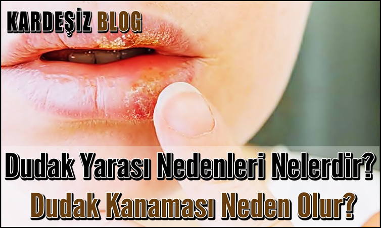 Dudak Yarası Nedenleri Nelerdir