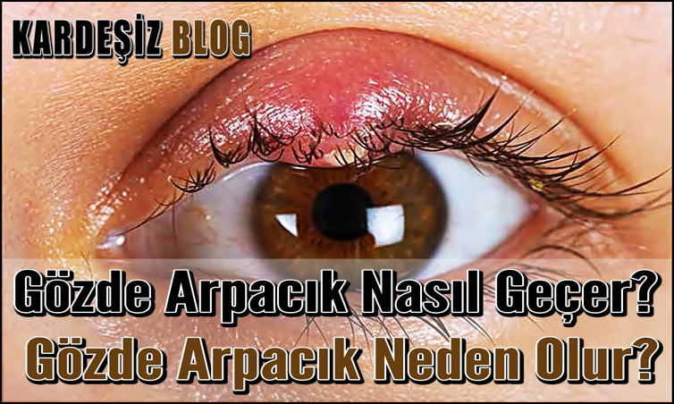 Gözde Arpacık Nasıl Geçer