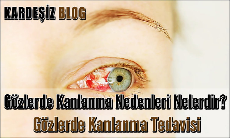 Gözlerde Kanlanma Nedenleri Nelerdir