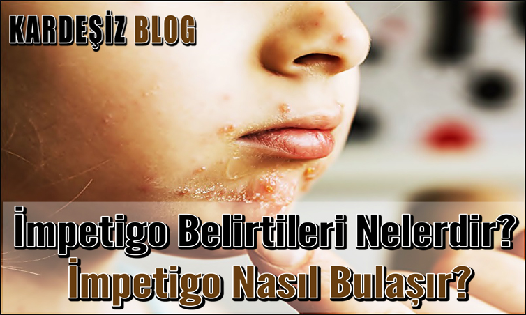 impetigo Belirtileri Nelerdir