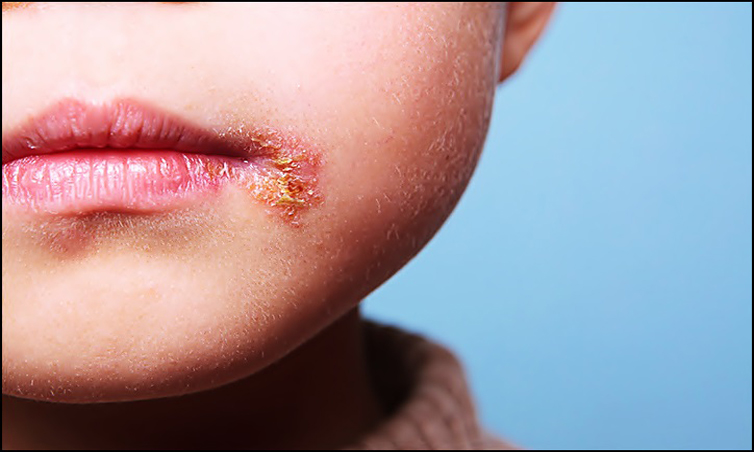 impetigo Ne Zaman Geçer