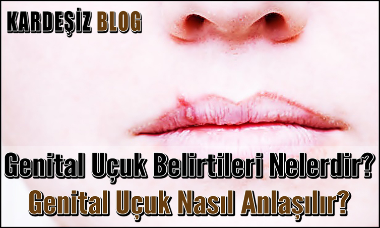 Genital Uçuk Belirtileri Nelerdir