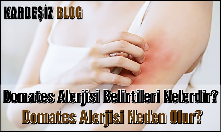 Domates Alerjisi Belirtileri Nelerdir