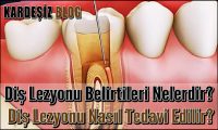 Diş Lezyonu Belirtileri Nelerdir