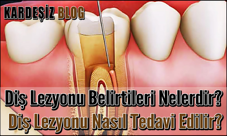 Diş Lezyonu Belirtileri Nelerdir