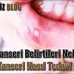 Ağız Kanseri Belirtileri Nelerdir