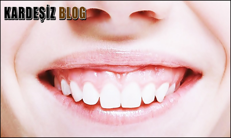 Gummy Smile Hastalık Mı