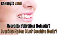 Overbite Belirtileri Nelerdir