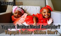 Yapışık ikizler Nasıl Anlaşılır